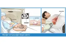 Akciğer Biyopsi Kimlere Yapılır?