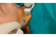 Lenf Biyopsi Nasıl Yapılır?