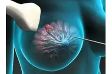 Meme Biyopsisi Nedir ve Nasıl Yapılır?