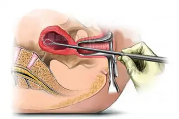 Endometrial Biyopsi Endemotrial Biyopsi Nasıl Yapılır?