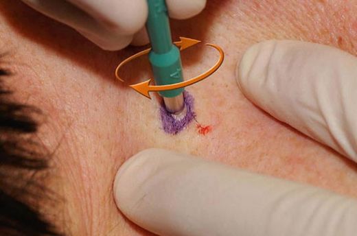 Biyopsi Nasıl Yapılır?