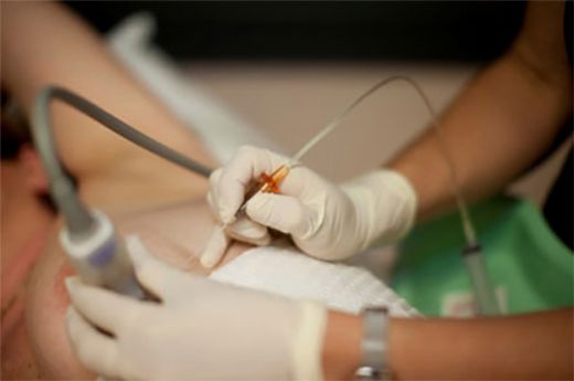 Gögüsten Biyopsi Alınması Nedir ve Nasıl Yapılır?