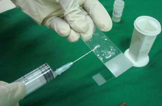 İnce İğne Aspirasyon Biyopsisi Nedir ve Nasıl Yapılır?