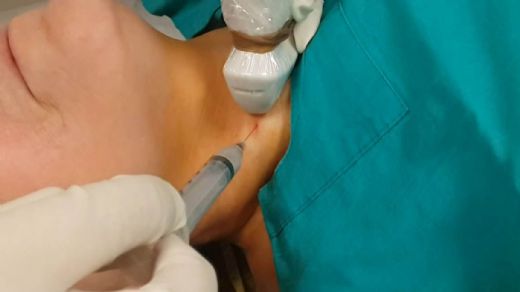 Lenf Biyopsi Nasıl Yapılır?